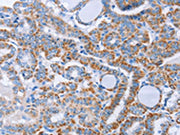 The image on the left is immunohistochemistry of paraffin-embedded Human thyroid cancer tissue using CSB-PA338217(KIF3A Antibody) at dilution 1/40, on the right is treated with fusion protein. (Original magnification: ×200)