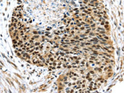The image on the left is immunohistochemistry of paraffin-embedded Human esophagus cancer tissue using CSB-PA339675(UBA1 Antibody) at dilution 1/40, on the right is treated with synthetic peptide. (Original magnification: ×200)