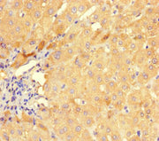 Immunohistochemistry of paraffin-embedded human liver cancer using CSB-PA339756HA01HU at dilution of 1:100