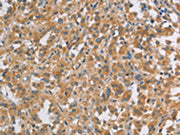 The image on the left is immunohistochemistry of paraffin-embedded Human thyroid cancer tissue using CSB-PA343705(DDX53 Antibody) at dilution 1/40, on the right is treated with fusion protein. (Original magnification: ×200)