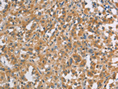 The image on the left is immunohistochemistry of paraffin-embedded Human thyroid cancer tissue using CSB-PA343705(DDX53 Antibody) at dilution 1/40, on the right is treated with fusion protein. (Original magnification: ×200)