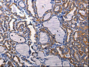 The image on the left is immunohistochemistry of paraffin-embedded Human thyroid cancer tissue using CSB-PA343762(DRD1 Antibody) at dilution 1/50, on the right is treated with synthetic peptide. (Original magnification: ×200)