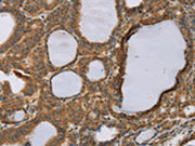 The image on the left is immunohistochemistry of paraffin-embedded Human thyroid cancer tissue using CSB-PA345004(RNF5 Antibody) at dilution 1/35, on the right is treated with synthetic peptide. (Original magnification: ×200)