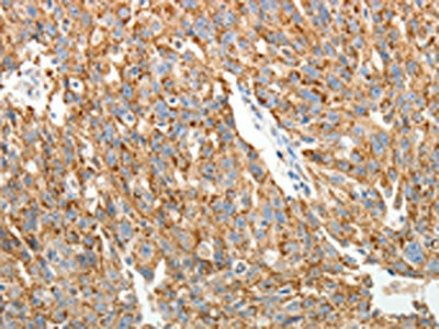 The image on the left is immunohistochemistry of paraffin-embedded Human ovarian cancer tissue using CSB-PA345280(COL4A3 Antibody) at dilution 1/20, on the right is treated with synthetic peptide. (Original magnification: ×200)