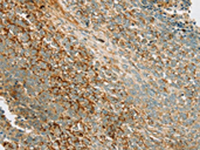 The image on the left is immunohistochemistry of paraffin-embedded Human ovarian cancer tissue using CSB-PA345903(PRKAA1 Antibody) at dilution 1/70, on the right is treated with synthetic peptide. (Original magnification: ×200)
