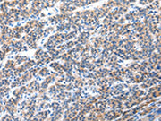 The image on the left is immunohistochemistry of paraffin-embedded Human liver cancer tissue using CSB-PA346332(CFC1 Antibody) at dilution 1/30, on the right is treated with synthetic peptide. (Original magnification: ×200)