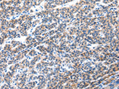 The image on the left is immunohistochemistry of paraffin-embedded Human liver cancer tissue using CSB-PA346332(CFC1 Antibody) at dilution 1/30, on the right is treated with synthetic peptide. (Original magnification: ×200)
