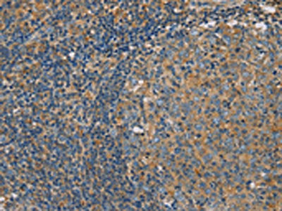The image on the left is immunohistochemistry of paraffin-embedded Human tonsil tissue using CSB-PA347049(CLIC1 Antibody) at dilution 1/30, on the right is treated with fusion protein. (Original magnification: ×200)