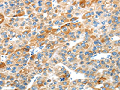 The image on the left is immunohistochemistry of paraffin-embedded Human liver cancer tissue using CSB-PA347467(PLXNB2 Antibody) at dilution 1/20, on the right is treated with synthetic peptide. (Original magnification: ×200)