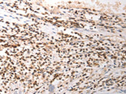 The image on the left is immunohistochemistry of paraffin-embedded Human gastic cancer tissue using CSB-PA350067(VTCN1 Antibody) at dilution 1/25, on the right is treated with synthetic peptide. (Original magnification: ×200)