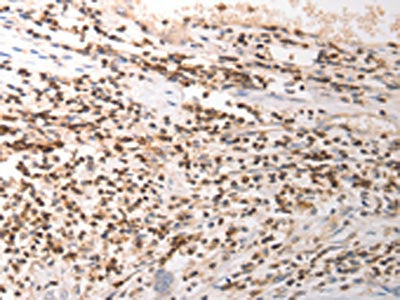 The image on the left is immunohistochemistry of paraffin-embedded Human gastic cancer tissue using CSB-PA350067(VTCN1 Antibody) at dilution 1/25, on the right is treated with synthetic peptide. (Original magnification: ×200)