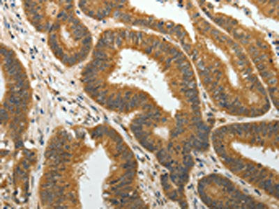The image on the left is immunohistochemistry of paraffin-embedded Human colon cancer tissue using CSB-PA350868(PTP4A2 Antibody) at dilution 1/25, on the right is treated with fusion protein. (Original magnification: ×200)