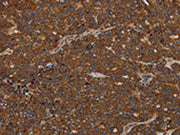 The image on the left is immunohistochemistry of paraffin-embedded Human ovarian cancer tissue using CSB-PA356766(GDF2 Antibody) at dilution 1/40, on the right is treated with synthetic peptide. (Original magnification: ×200)