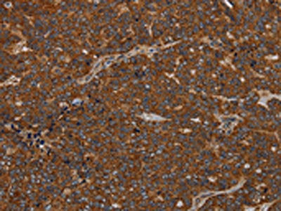The image on the left is immunohistochemistry of paraffin-embedded Human ovarian cancer tissue using CSB-PA356766(GDF2 Antibody) at dilution 1/40, on the right is treated with synthetic peptide. (Original magnification: ×200)