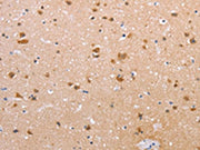 The image on the left is immunohistochemistry of paraffin-embedded Human brain tissue using CSB-PA358271(CLDN10 Antibody) at dilution 1/50, on the right is treated with synthetic peptide. (Original magnification: ×200)