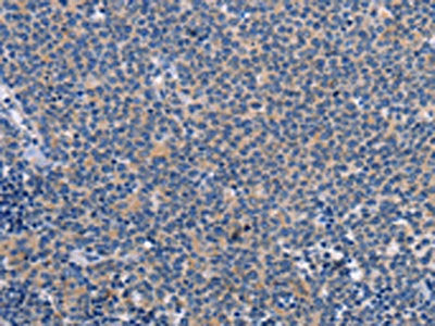 The image on the left is immunohistochemistry of paraffin-embedded Human Lymphoma tissue using CSB-PA358929(CTSC Antibody) at dilution 1/25, on the right is treated with synthetic peptide. (Original magnification: ×200)