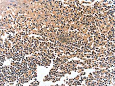 The image on the left is immunohistochemistry of paraffin-embedded Human tonsil tissue using CSB-PA358941(GRB10 Antibody) at dilution 1/12, on the right is treated with synthetic peptide. (Original magnification: ×200)