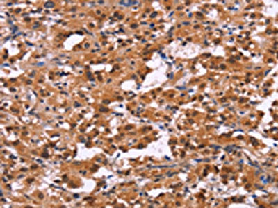 The image on the left is immunohistochemistry of paraffin-embedded Human thyroid cancer tissue using CSB-PA360041(XPO1 Antibody) at dilution 1/25, on the right is treated with fusion protein. (Original magnification: ×200)