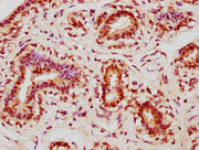 IHC image of CSB-PA361848LA01HU diluted at 1:400 and staining in paraffin-embedded human breast cancer performed on a Leica BondTM system. After dewaxing and hydration, antigen retrieval was mediated by high pressure in a citrate buffer (pH 6.0)....