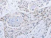 The image on the left is immunohistochemistry of paraffin-embedded Human esophagus cancer tissue using CSB-PA362118(CAMK2B Antibody) at dilution 1/25, on the right is treated with fusion protein. (Original magnification: ×200)