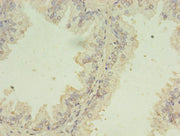 Immunohistochemistry of paraffin-embedded human prostate cancer using CSB-PA362460LA01HU at dilution of 1:100