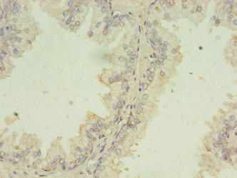 Immunohistochemistry of paraffin-embedded human prostate cancer using CSB-PA362460LA01HU at dilution of 1:100