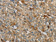The image on the left is immunohistochemistry of paraffin-embedded Human liver cancer tissue using CSB-PA362770(SYCP3 Antibody) at dilution 1/25, on the right is treated with synthetic peptide. (Original magnification: ×200)