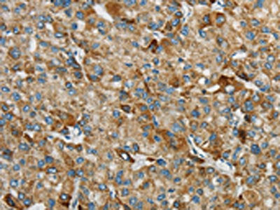 The image on the left is immunohistochemistry of paraffin-embedded Human liver cancer tissue using CSB-PA362770(SYCP3 Antibody) at dilution 1/25, on the right is treated with synthetic peptide. (Original magnification: ×200)