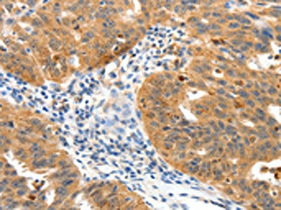 The image on the left is immunohistochemistry of paraffin-embedded Human ovarian cancer tissue using CSB-PA362939(TPM2 Antibody) at dilution 1/25, on the right is treated with synthetic peptide. (Original magnification: ×200)