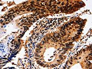 The image on the left is immunohistochemistry of paraffin-embedded Human colon cancer tissue using CSB-PA363619(YWHAE Antibody) at dilution 1/10, on the right is treated with fusion protein. (Original magnification: ×200)