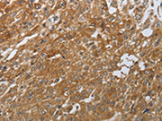 The image on the left is immunohistochemistry of paraffin-embedded Human esophagus cancer tissue using CSB-PA364182(PTPRM Antibody) at dilution 1/80, on the right is treated with synthetic peptide. (Original magnification: ×200)