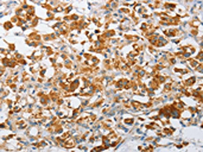 The image on the left is immunohistochemistry of paraffin-embedded Human thyroid cancer tissue using CSB-PA364661(ARHGEF9 Antibody) at dilution 1/50, on the right is treated with fusion protein. (Original magnification: ×200)