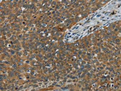The image on the left is immunohistochemistry of paraffin-embedded Human cervical cancer tissue using CSB-PA365158(E2F6 Antibody) at dilution 1/60, on the right is treated with fusion protein. (Original magnification: ×200)