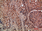 Immunohistochemical analysis of paraffin-embedded human-lung-cancer, antibody was diluted at 1:200