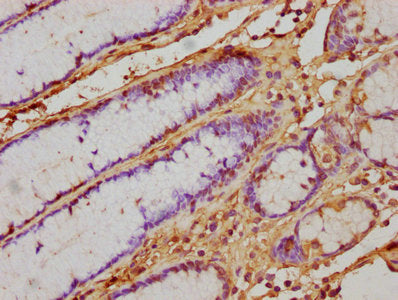 IHC image of CSB-PA365592HA01HU diluted at 1:500 and staining in paraffin-embedded human gastric cancer performed on a Leica BondTM system. After dewaxing and hydration, antigen retrieval was mediated by high pressure in a citrate buffer (pH 6.0)....