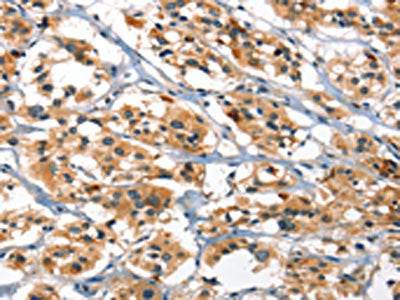 The image on the left is immunohistochemistry of paraffin-embedded Human thyroid cancer tissue using CSB-PA366900(DEFA1/3 Antibody) at dilution 1/30, on the right is treated with synthetic peptide. (Original magnification: ×200)