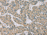 The image on the left is immunohistochemistry of paraffin-embedded Human liver cancer tissue using CSB-PA367981(RNASE3 Antibody) at dilution 1/20, on the right is treated with fusion protein. (Original magnification: ×200)