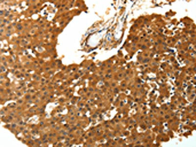The image on the left is immunohistochemistry of paraffin-embedded Human breast cancer tissue using CSB-PA371951(SKP1 Antibody) at dilution 1/30, on the right is treated with fusion protein. (Original magnification: ×200)