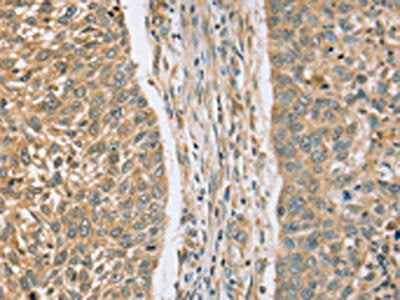 The image on the left is immunohistochemistry of paraffin-embedded Human lung cancer tissue using CSB-PA372717(RASSF4 Antibody) at dilution 1/25, on the right is treated with fusion protein. (Original magnification: ×200)