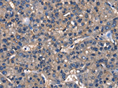 The image on the left is immunohistochemistry of paraffin-embedded Human liver cancer tissue using CSB-PA372865(IGFBP5 Antibody) at dilution 1/25, on the right is treated with fusion protein. (Original magnification: ×200)