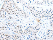 The image on the left is immunohistochemistry of paraffin-embedded Human lung cancer tissue using CSB-PA374601(POU2F1 Antibody) at dilution 1/25, on the right is treated with fusion protein. (Original magnification: ×200)