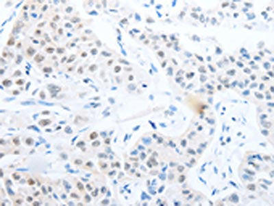 The image on the left is immunohistochemistry of paraffin-embedded Human lung cancer tissue using CSB-PA374601(POU2F1 Antibody) at dilution 1/25, on the right is treated with fusion protein. (Original magnification: ×200)