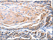 The image on the left is immunohistochemistry of paraffin-embedded Human cervical cancer tissue using CSB-PA376378(KRT5 Antibody) at dilution 1/25, on the right is treated with synthetic peptide. (Original magnification: ×200)