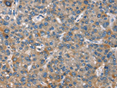 The image on the left is immunohistochemistry of paraffin-embedded Human liver cancer tissue using CSB-PA377075(GINS1 Antibody) at dilution 1/25, on the right is treated with synthetic peptide. (Original magnification: ×200)