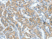 The image on the left is immunohistochemistry of paraffin-embedded Human lung cancer tissue using CSB-PA378255(CKAP4 Antibody) at dilution 1/30, on the right is treated with synthetic peptide. (Original magnification: ×200)