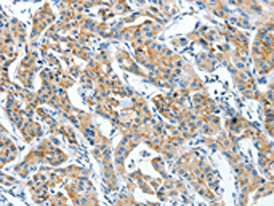 The image on the left is immunohistochemistry of paraffin-embedded Human lung cancer tissue using CSB-PA378255(CKAP4 Antibody) at dilution 1/30, on the right is treated with synthetic peptide. (Original magnification: ×200)
