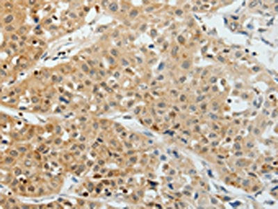 The image on the left is immunohistochemistry of paraffin-embedded Human lung cancer tissue using CSB-PA379558(VEGFA Antibody) at dilution 1/25, on the right is treated with synthetic peptide. (Original magnification: ×200)