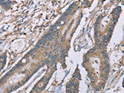 The image on the left is immunohistochemistry of paraffin-embedded Human colorectal cancer tissue using CSB-PA382337(SASH1 Antibody) at dilution 1/20, on the right is treated with synthetic peptide. (Original magnification: ×200)