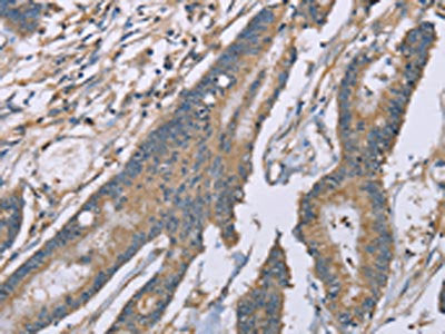 The image on the left is immunohistochemistry of paraffin-embedded Human colorectal cancer tissue using CSB-PA382337(SASH1 Antibody) at dilution 1/20, on the right is treated with synthetic peptide. (Original magnification: ×200)