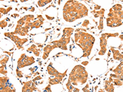 The image on the left is immunohistochemistry of paraffin-embedded Human breast cancer tissue using CSB-PA383927(ACSM5 Antibody) at dilution 1/20, on the right is treated with fusion protein. (Original magnification: ×200)